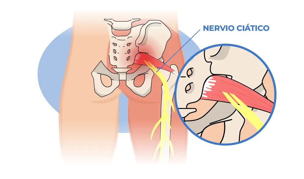 Lumbociática y hernia discal lumbar