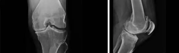 Osteoartritis (artrosis) de rodilla  Revista Chilena de Ortopedia y  Traumatología